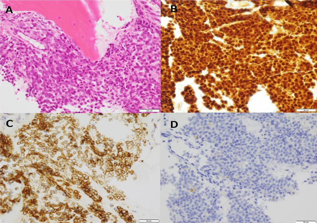 Utility of FDG PET in Ra-223 Therapy Maruyama K et al Figure 5. The images of a bone marrow biopsy are shown. Hematoxylin and eosin stain (A), 400.