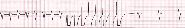 What an ICD Does An ICD can do one or more of the following: Antitachycardia pacing (ATP): When VT occurs, the ICD sends out a series of impulses. These may make the rhythm return to normal.