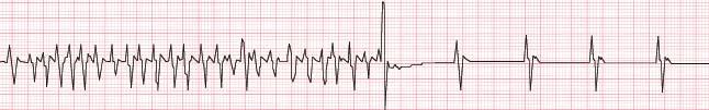 When this happens, the ICD gives the heart one or more small shocks. These stop the fast rhythm for a moment. When the heart rhythm resumes, it usually goes back to normal.