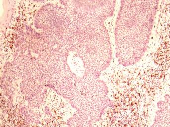 CD 68 antigēns tika konstatēts monocitāri makrofagālās sistēmas šūnās un arī Langhansa šūnās gan neizmainītā epidermā, gan audzēja iekšienē.