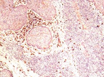 7. attēls. CD 117, c-kit ekspresija tuklajās šūnās pie bazālās šūnas karcinomas robežām, 200, DacoCytomation.