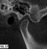 StomatoloģIJA 1. attēls. Normāla TML galviņas skeletālā morfoloģija (A, B). Normal osseous morphology of the temporomandibular joint. A B 2. attēls. Izmainīta TML galviņas skeletālā morfoloģija kondilāra hipoplāzija, virsmas saplacināšanās (A, B).
