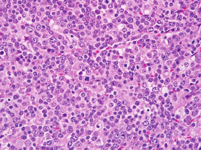 Case Reports in Hematology 3 (a) (b) (c) (d) Figure 1: (a) The lymph node is effaced by an infiltrate of lymphocytes with range of cytologic features ranging from large lymphocytes with prominent