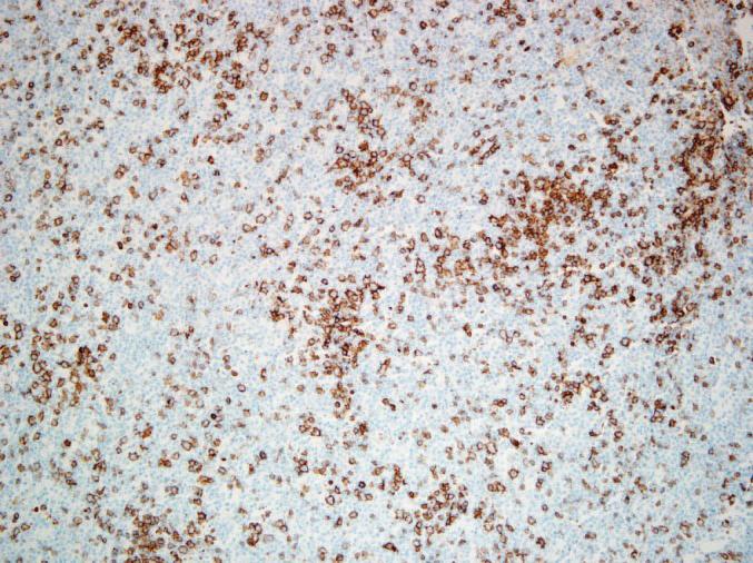 (b) Paraffin immunohistochemistry using antibodies against CD20 highlights B-cells with focal loose clusters (CD20, 100x magnification).