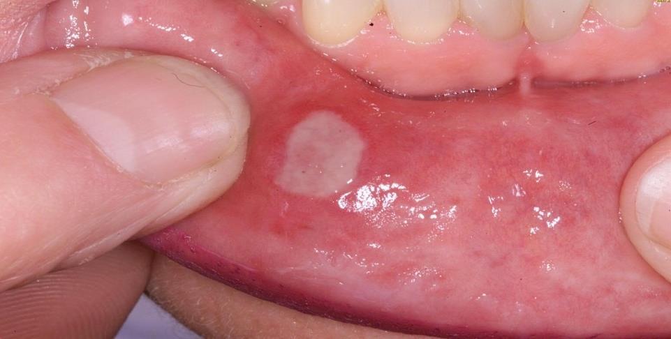 The most likely diagnosis is: A. Aphthous stomatitis B.