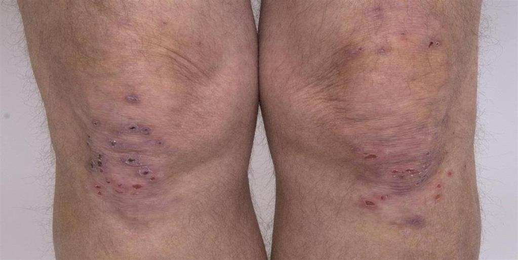 A 60 year old man presents with severely itchy blisters on the elbows, knees and upper back.