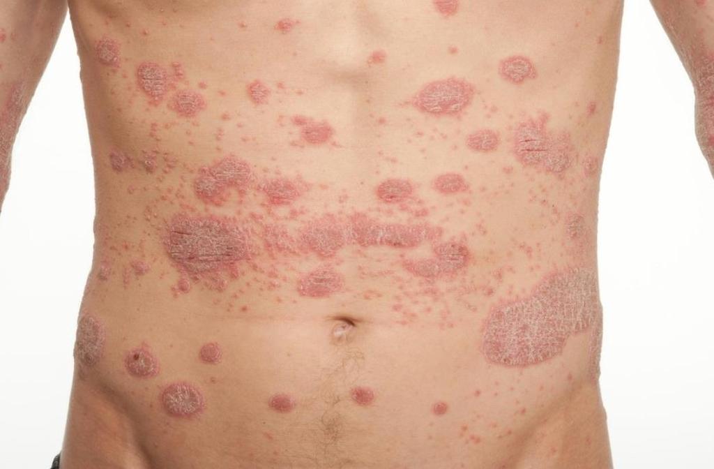 The most likely diagnosis is: A. Allergic contact dermatitis B.