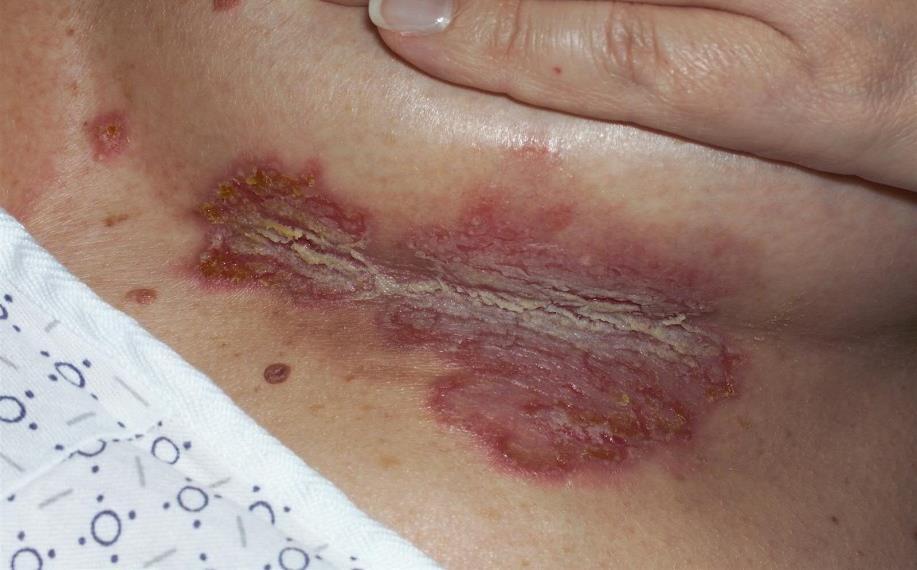 A 37 year-old woman presents with a 3 year history painful erosions in the skin folds that heal leaving scars.