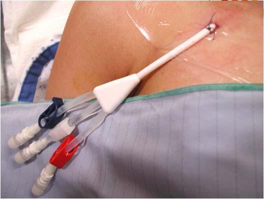Central Venous Catheters Required for
