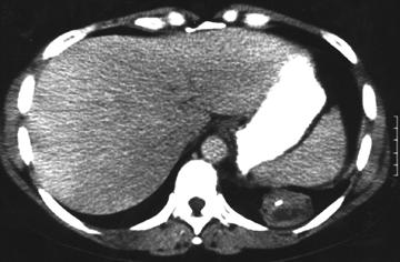 Histopathological analysis showed the presence of xanthogranulomatous pyelonephritis (XPGN) of the left kidney which caused the formation of a nephrobronchial fistulous tract.