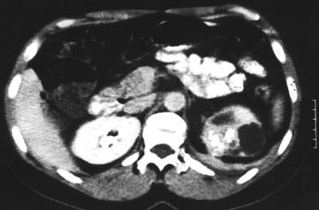 FIGURE 4. Mass in the upper pole of the left kidney. XPGN is an aggressive subtype of common chronic pyelonephritis.