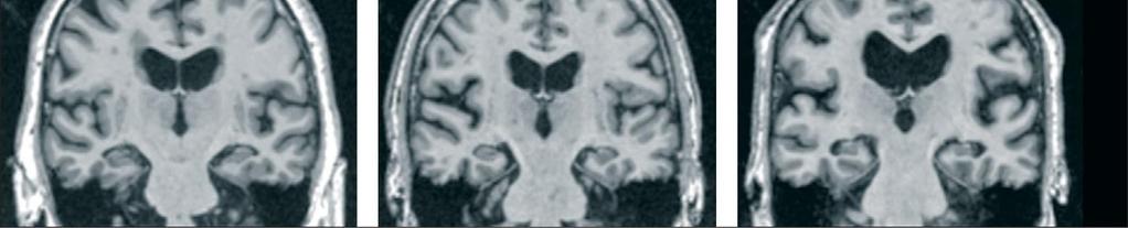 Lancet Neurol 2010:9:119-28 Cognitively