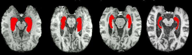 MRI MCI amyloid on PET No atrophy on