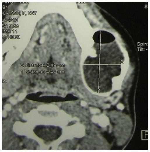 CT scan was done and revealed the same lesion with An expansile osteolytic lesion involving the left side of mandible and ramus region with internally areas of hypodensity noted.