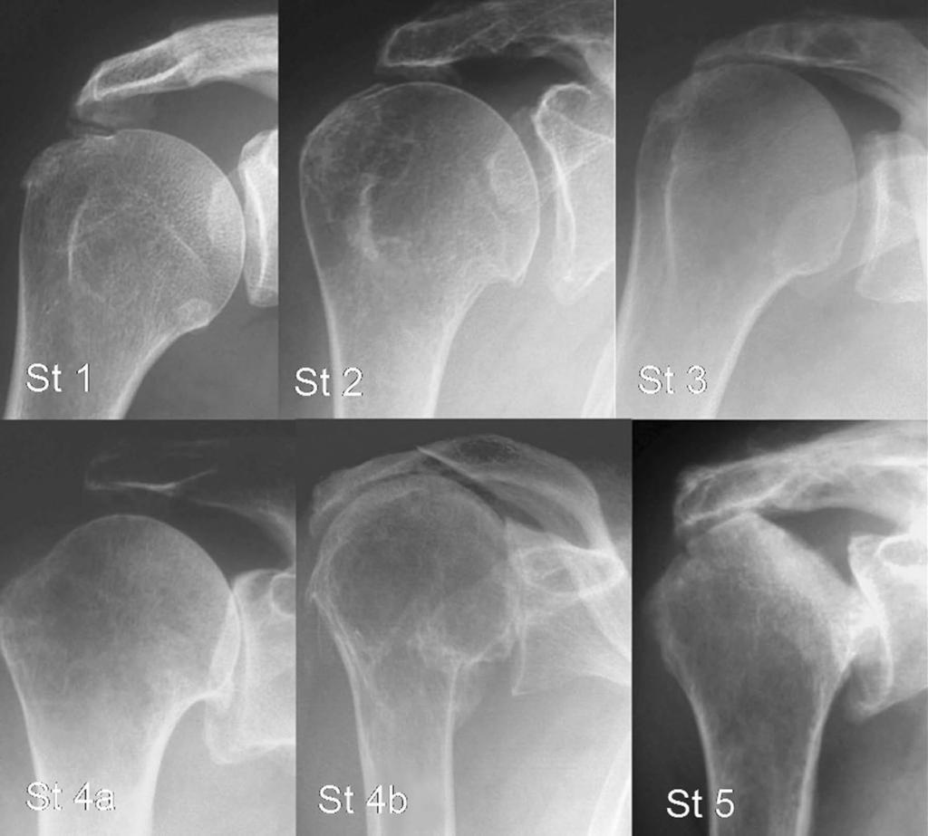 1478 Fig. 1 Radiographs demonstrating the classification of massive rotator cuff tears according to the system of Hamada et al. 18, as described in the text. St = stage.