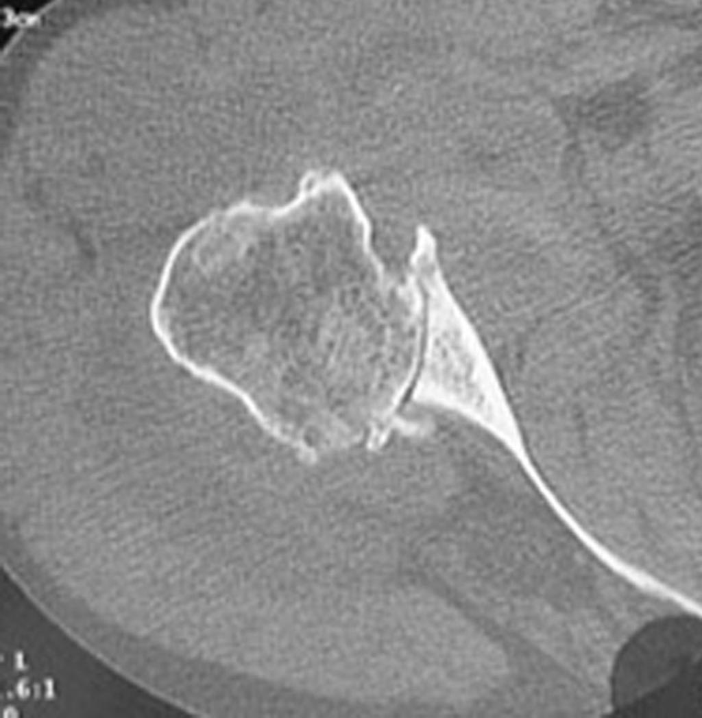 3-A and 3-B Radiograph and computed tomography scan demonstrating primary osteoarthritis with severe static posterior instability of the humeral head and posterior erosion of the glenoid.