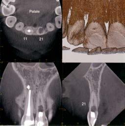 Internal REPLACEMENT Resorption When is it necessary to undertake RCT
