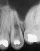 changes and dentine is resorbed and replaced by bone-like hard tissue.