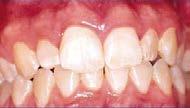 luxation. Tooth 22: no major displacement - concussion? Symptomatic. TTP. CO2 negative. Mild grey discolouration.