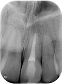 infected root canal system. 04/10/11 Decision was made to strictly monitor this tooth.
