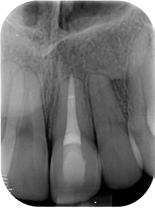 Horizontal Root Fracture 12 year old male Subluxation 11 Three weeks prior No