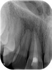 February 2012 Dx: Pulp necrosis with INFECTION and symptomatic apical periodontitis.
