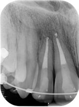 Localised Tertiary Dentine Localised (focal deposition) tertiary dentine : Complicated crown fractures & vital pulp therapy - Cvek