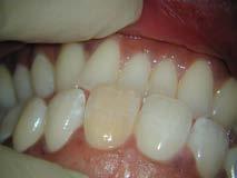 Pre-op 6-months 12-months C/O: discoloured front tooth Hx: