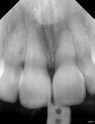 CO2 negative, but EPT positive. No periapical radiolucency.