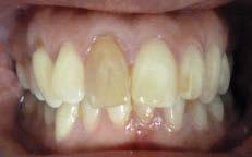C/O: discoloured front tooth Hx: 11- Impact trauma when