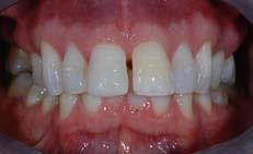 and/or aesthetic concerns Elective RCT Vital bleaching Partial coverage restoration Non-vital