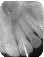 perforation Root