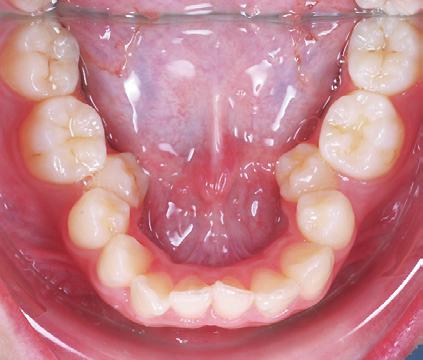 premolar to lower first molar,