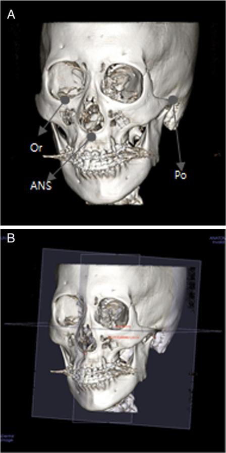 Kim et al. Maxillofacial Plastic and Reconstructive Surgery (2015) 37:36 Page 3 of 7 Fig.