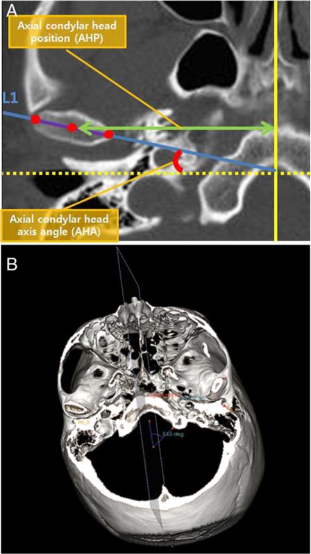 Axial condylar head long-axis line was drawn along the axis of the condylar head from the lateral pole to the medial pole (a, b) Fig.