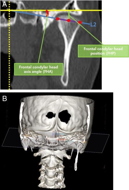 Kim et al. Maxillofacial Plastic and Reconstructive Surgery (2015) 37:36 Page 4 of 7 Fig.