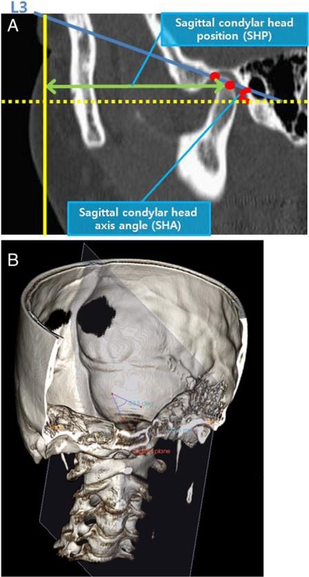 Frontal condylar head long-axis line was drawn along the axis of the condylar head from the lateral pole to the medial pole (a, b) the right surgical site.