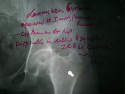 Figure 17 Table 10 Because of collapse, at fracture site, some shortening was present in all patients, Limb