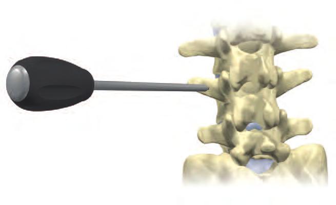 Step 1 A Bone Awl is used to penetrate the cortical bone at the pedicle entry point.