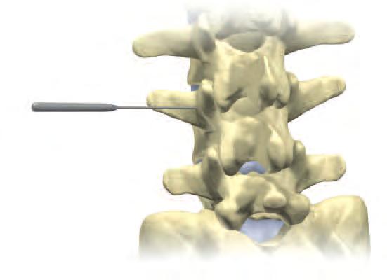 Step 2 A Pedicle Probe is used to create a pilot hole for the pedicle screw. The Pedicle Probe is driven into the pilot hole and pedicle under radiological guidance.