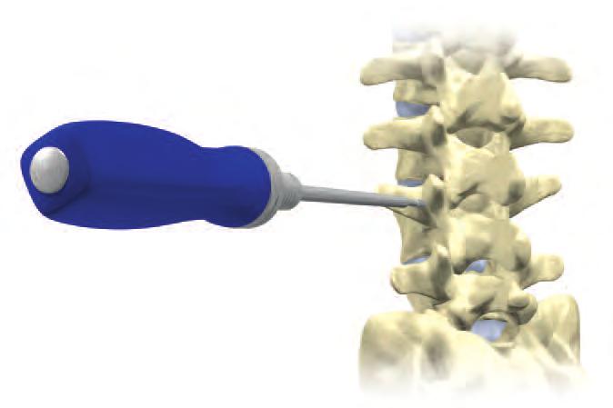 Step 4 Using preoperative and intraoperative radiographs, the appropriate pedicle screw size is determined. The screws are available in 4.75, 5.5, 6.5, 7.5 and 8.