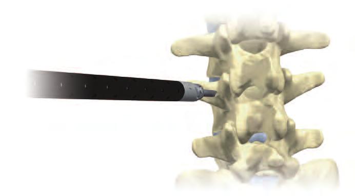 screw top. The screw should be driven from 50 to 67% of the AP dimension of the vertebral body and centered within the pedicle.