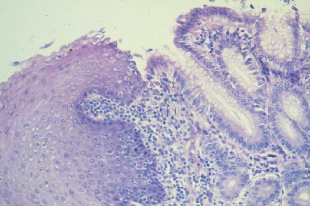Gastroesophageal Junction stratified squamous lining of the esophagus