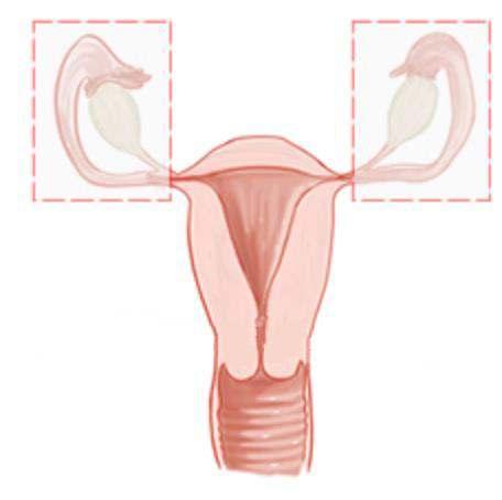 RECOMMENDATIONS FOR HIGH-RISK WOMEN Ovarian Cancer BSO when childbearing complete For those not ready, or unwilling, to