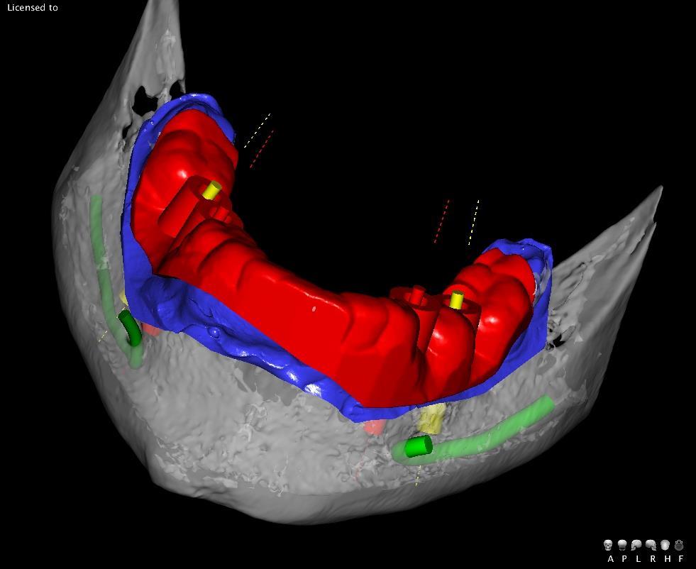 Demo video available on our YouTube channel Owandy Radiology (Superimpositioning_OWANDY RADIOLOGY_QuickVision 3D) Quick,