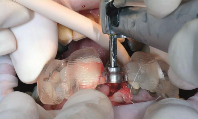 The implant is positioned using the guide,