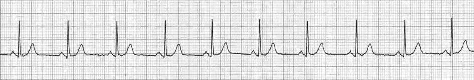 (c) The ECG below was recorded at rest. (i) This person had a resting heart rate of 74 beats per minute.