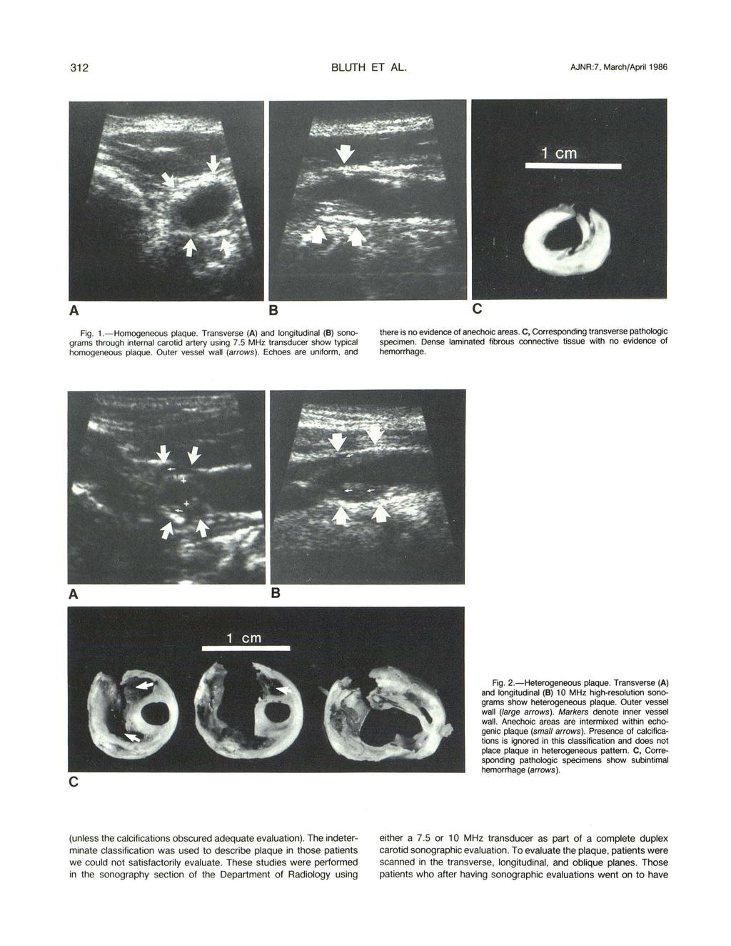 312 BLUTH ET AL. AJNR:7, March/April 1986 A B c Fig. 1.- Homogeneous plaque. Transverse (A) and longitudinal (B) sonograms through internal carotid artery using 7.
