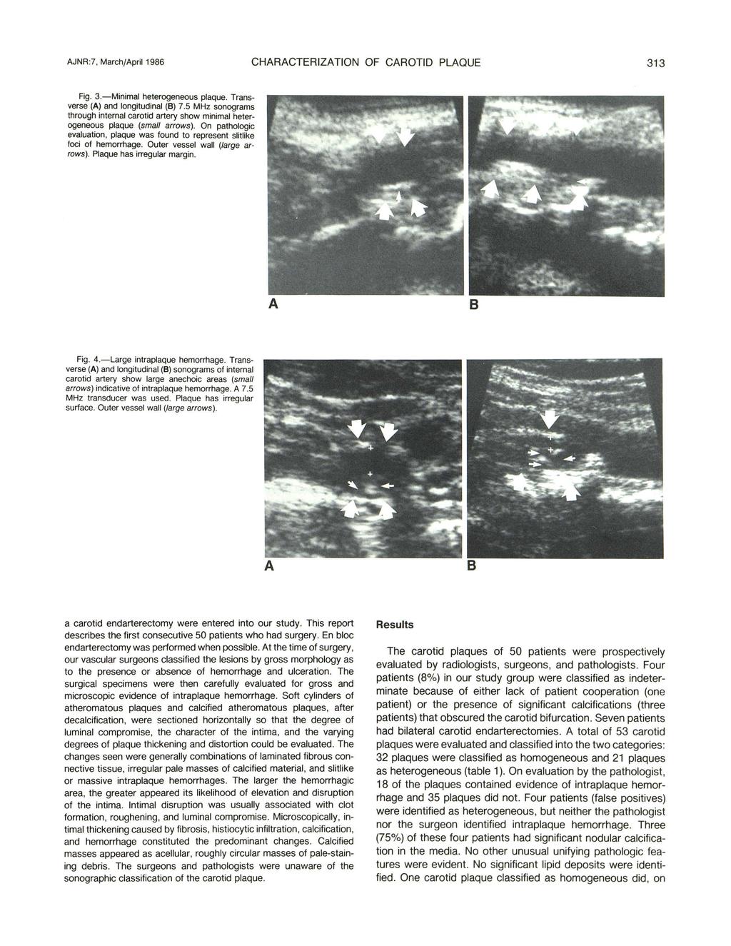 AJNR :7, March/April 1986 CHARACTERIZATION OF CAROTID PLAQUE 313 Fig. 3.-Minimal heterogeneous plaque. Transverse (A) and longitudinal (8) 7.
