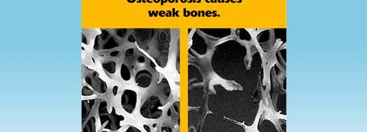 Bone health and osteoporosis: A report of the Surgeon